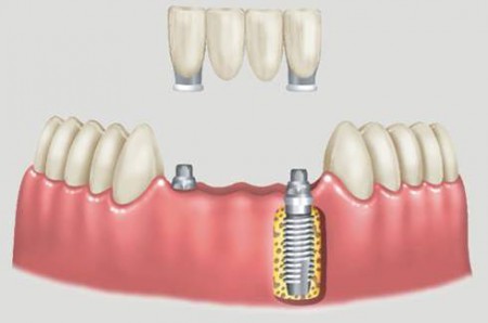 Implantes