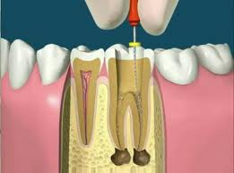 Endodontia(canal)